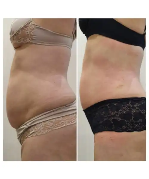 Fotografia de antes e depois de um procedimento estético