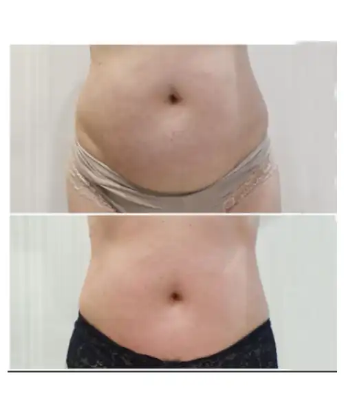 Fotografia de antes e depois de um procedimento estético