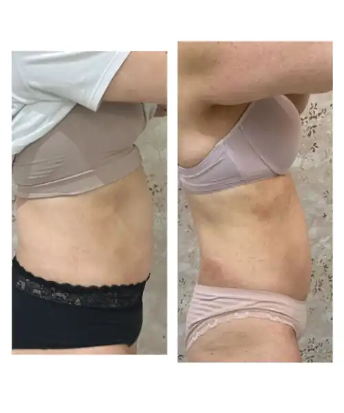 Fotografia de antes e depois de um procedimento estético