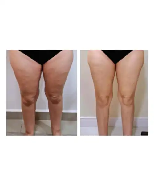 Fotografia de antes e depois de um procedimento estético